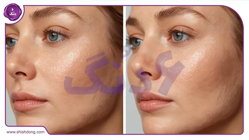 قبل و بعد هیدرافیشیال پوست خشک قبل عید