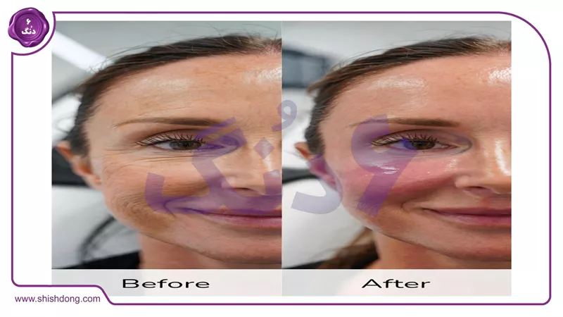 تزریق چربی به صورت برای حجم&zwnj;دهی طبیعی ۱۴۰۴