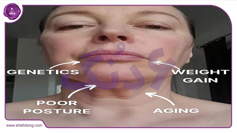 علل غبغب: ژنتیک و سبک زندگی