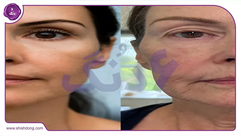 تاثیر پیری بر غبغب