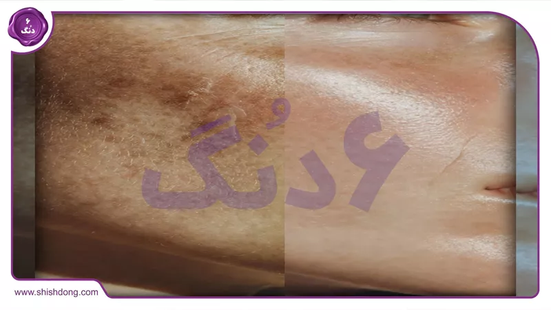 نتایج قبل و بعد نوروتراپی صورت