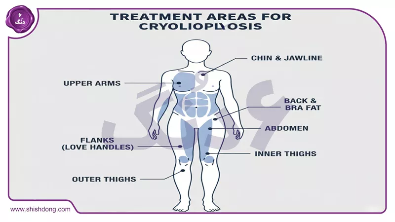 نواحی درمان کرایولیپولیز