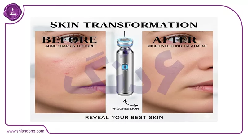 عکس قبل و بعد میکرونیدلینگ برای جای جوش و اسکار ۱۴۰۵